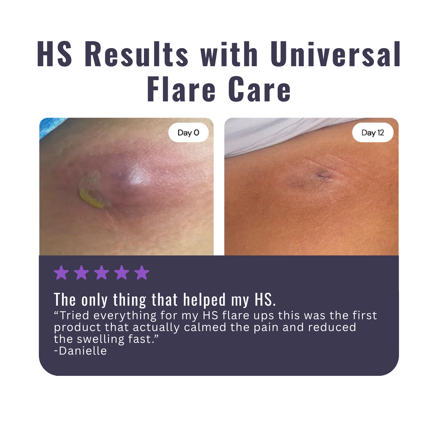 Hidradenitis Suppurativa (HS) Flare Care