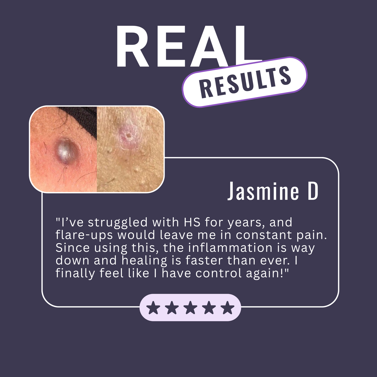 Hidradenitis Suppurativa (HS) Flare Care