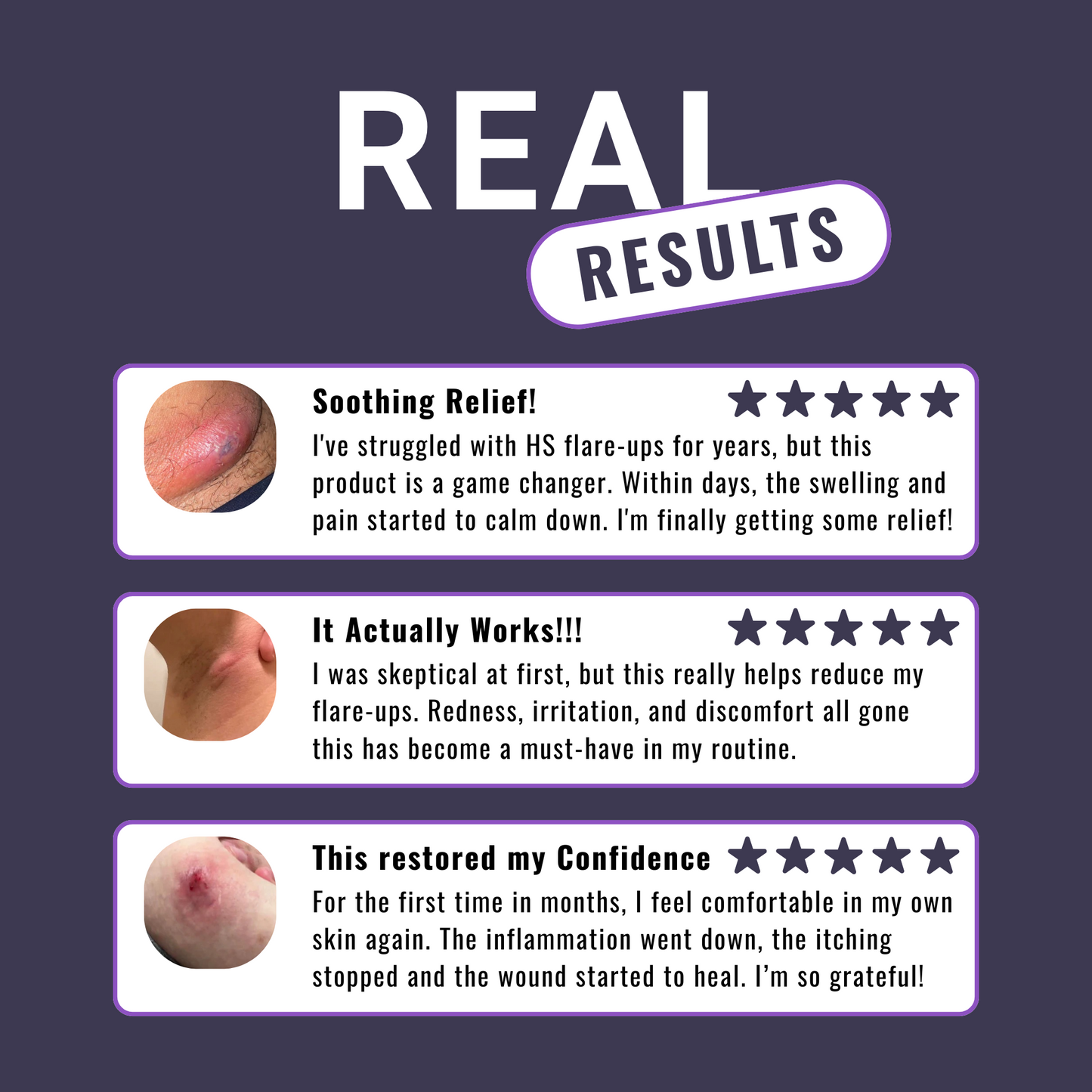 Hidradenitis Suppurativa (HS) Flare Care