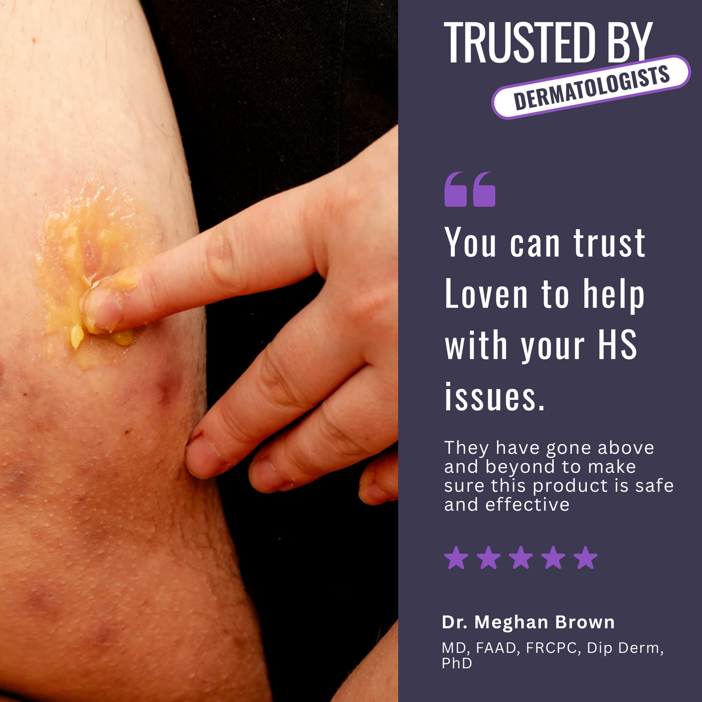 Hidradenitis Suppurativa (HS) Flare Care